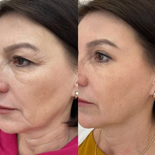 Antes e depois — depoimento 1